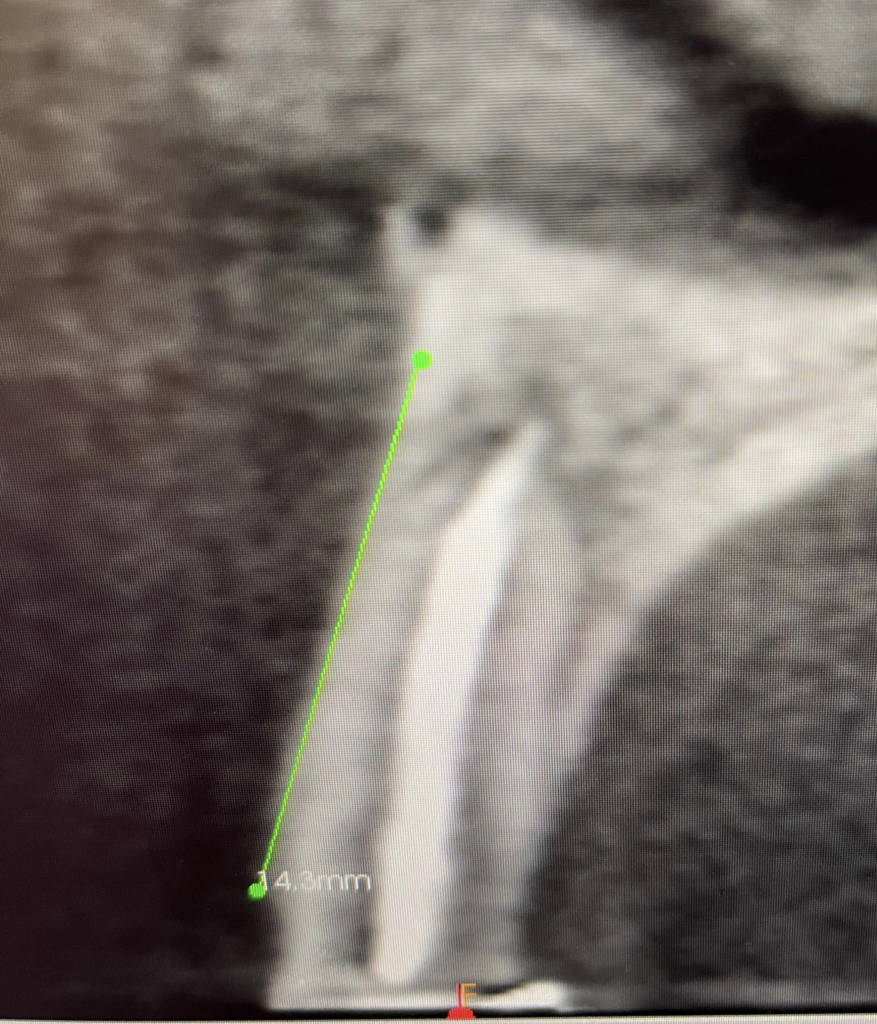除去が難しい既成ピンを有する再根管治療〜#9 Re-RCT+Core build up with Fiber Post - まつうら歯科医院 ...