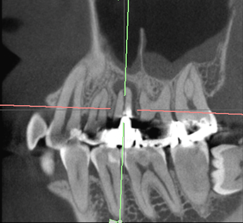4 D部 Perforation repair, Core build up with Fiber Post