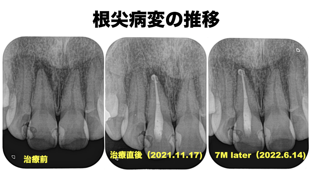 8 Pulp Necrosis, Chronic apical abscessの歯の根管治療から