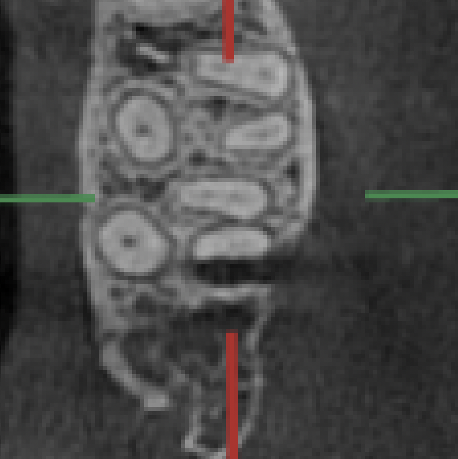 開口量の問題で根管形成がしにくい患者さんの根管治療〜#15 RCT+Core build up - まつうら歯科医院 歯内療法専門室