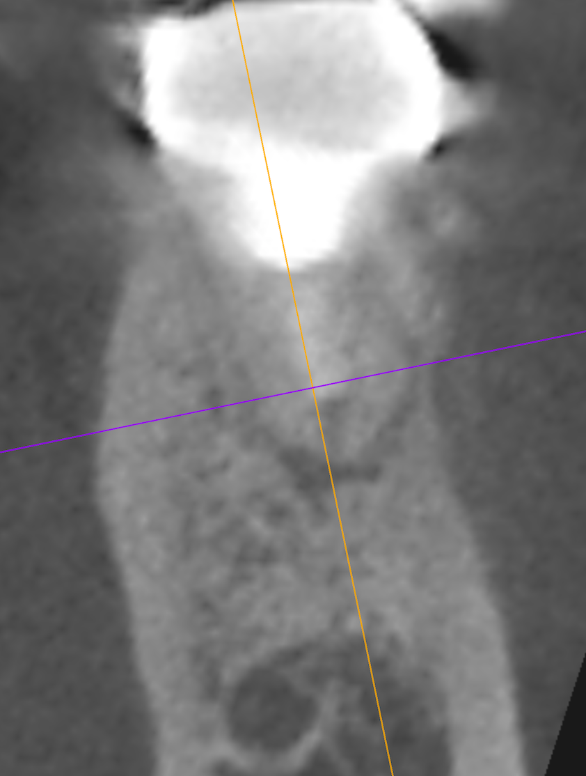 根管内から多量のブローチ綿花が…勤務医時代を思い出す#30 Re-RCT+Core build up with Fiber Post ...