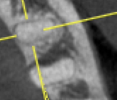 根管治療から6M Recall〜分岐部病変の運命は? #30 RCT+Core build up wo Fiber Postから半年経過 ...