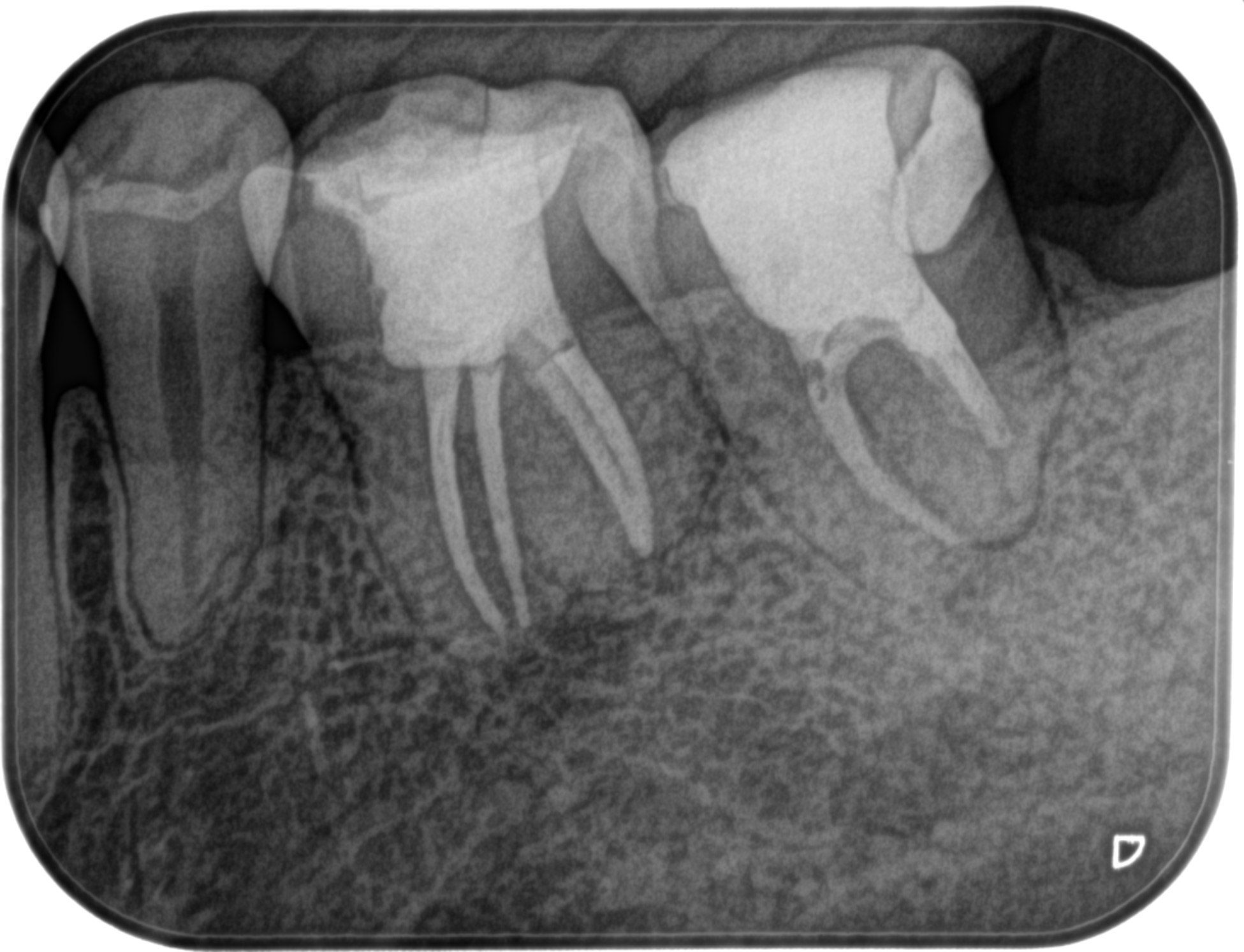 Previously Initiated Therapyの歯内療法は事実上、再根管治療…その 