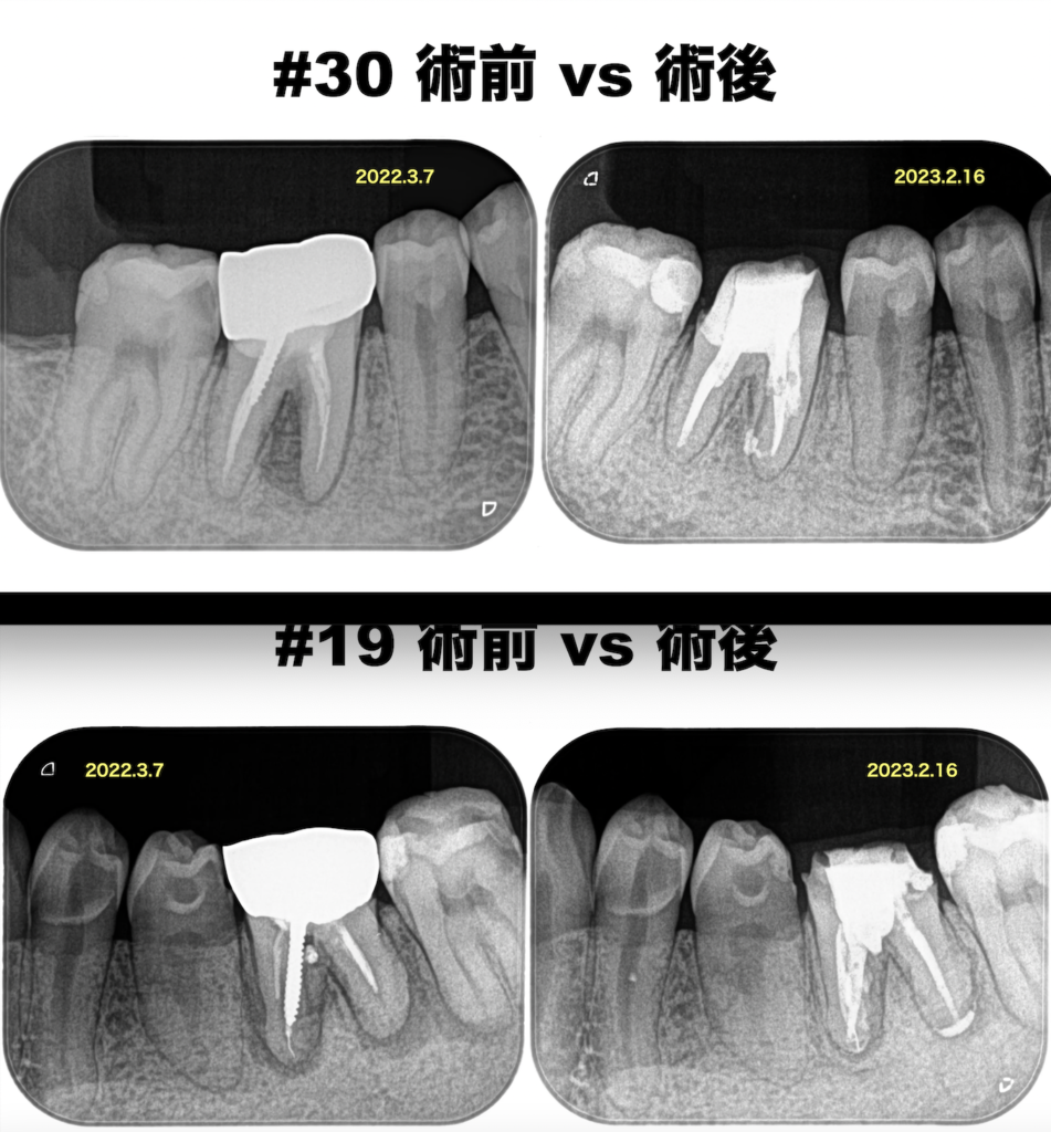 19, 30 根管に折れ込んだ破折ファイルを除去せずに根尖病変が治癒するのか？〜#19/30 Re-RCT 6M/1yr Recall - まつうら歯科医院  歯内療法専門室