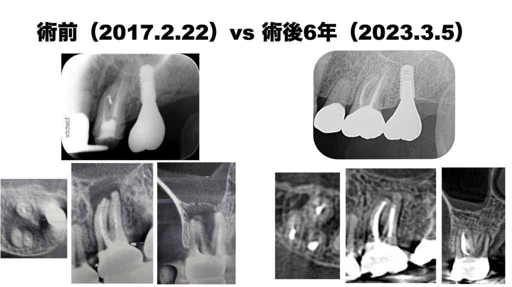 レッジができたMBの修正＋Re-RCTで歯槽骨は回復したのか？〜#14