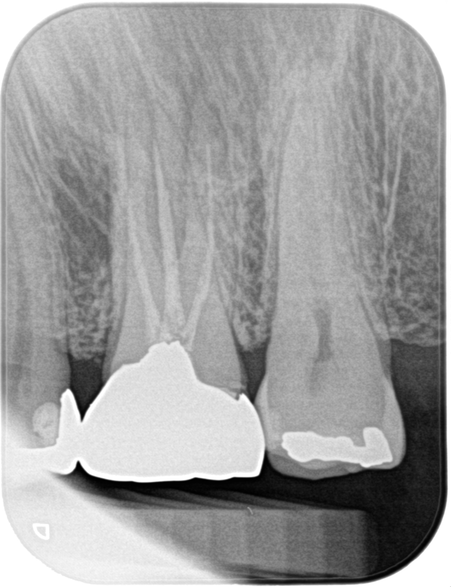 GBR GTR 14 Apicoectomy 2 gbr-gtr-14-apicoectomy-2