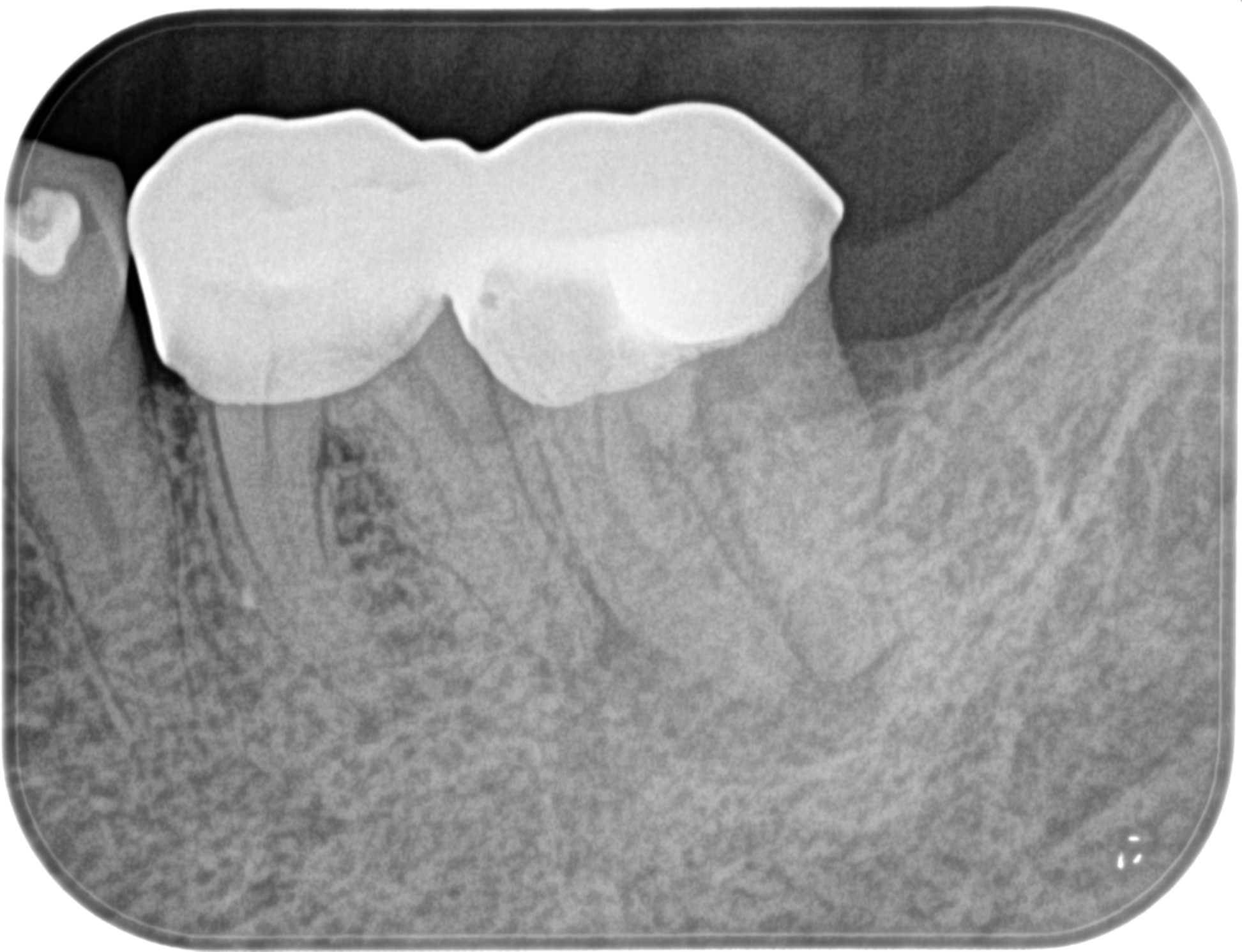 下顎の大臼歯は歯内療法専門医に任せた方が無難な理由〜#18 Initial 