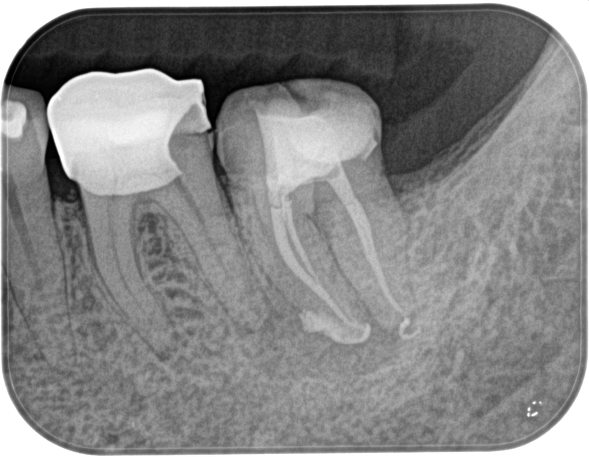 下顎の大臼歯は歯内療法専門医に任せた方が無難な理由〜#18 Initial 