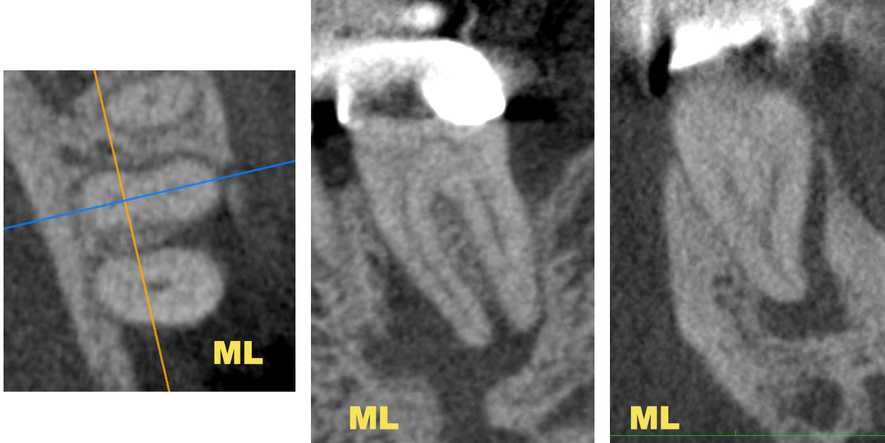 下顎の大臼歯は歯内療法専門医に任せた方が無難な理由〜#18 Initial 