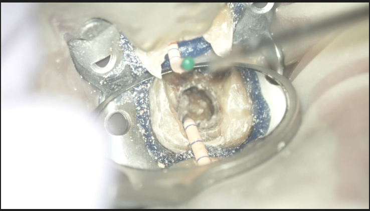 Intentional Replantationはしたくない！… C-shaped Root Canalの解剖学的特徴とは？〜#31 Re ...