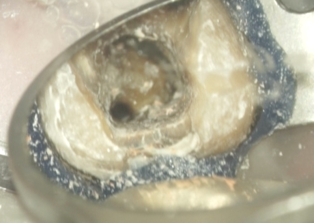 Intentional Replantationはしたくない！… C-shaped Root Canalの解剖学的特徴とは？〜#31 Re ...