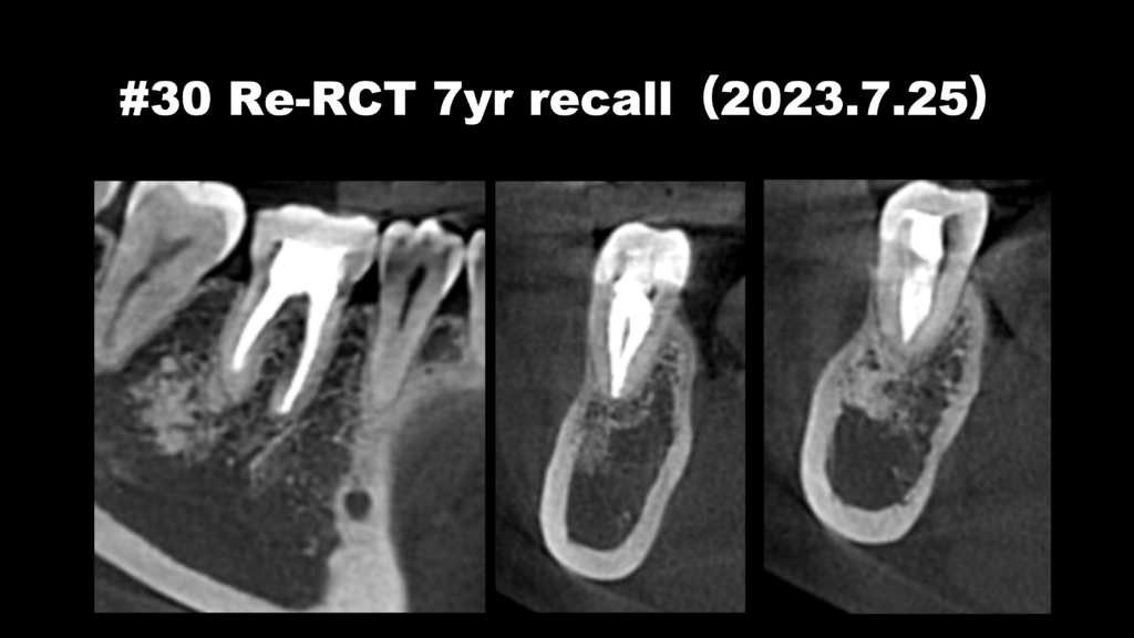 根尖病変のない歯の再根管治療で痛みは取れるのか？〜#30 Re-RCT 