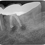 下顎大臼歯2根同時の歯根端切除術の時短のコツとは？〜#19 M, D Apicoectomy