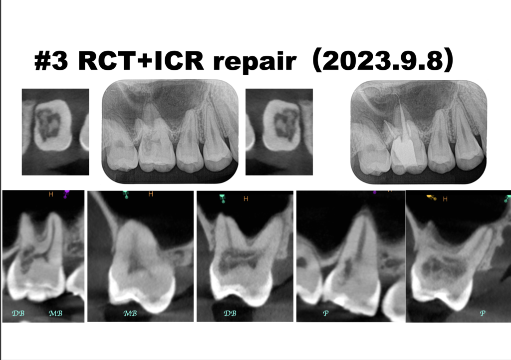 Invasive Cervical Root Resorptionの治療に対する有効的な道具とは？〜#3 RCT+Invasive ...