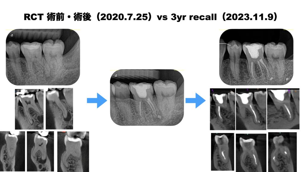 歯内療法Next Step　樋状根とRadix Entomolarisへの対応 歯内療法Next Step 樋状根とRadix Entomolarisへの対応―日本人に