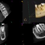 左の上下の歯が痛い…＋ファイルが折れた時の臨床的対応方法〜#19 RCT 1回法