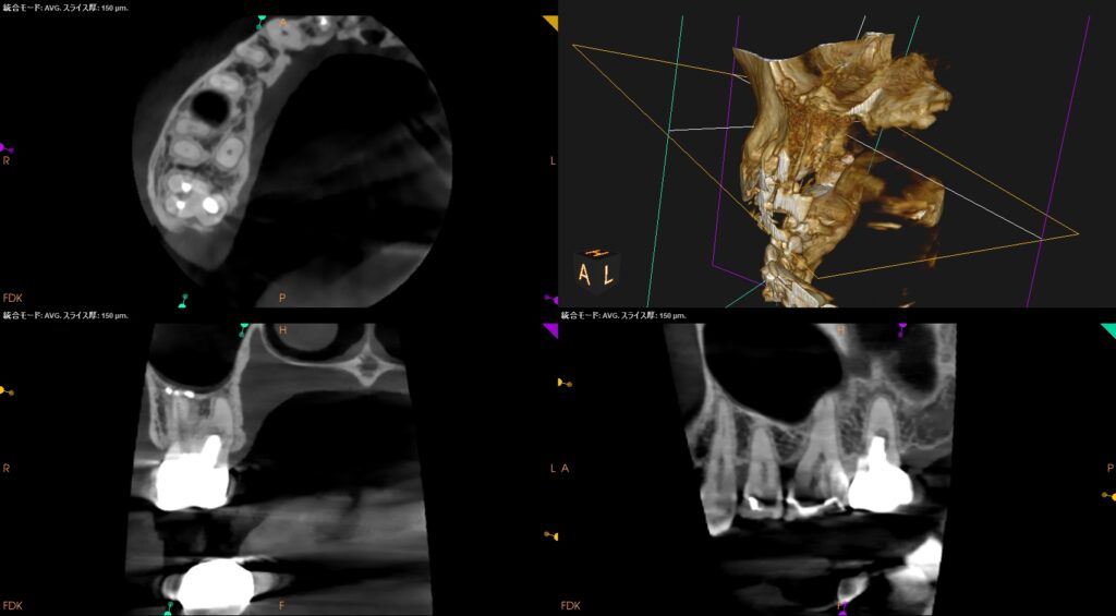 Previously Initiated therapyの根管治療から8年経過〜#2 RCT＋Perforation Repair ...