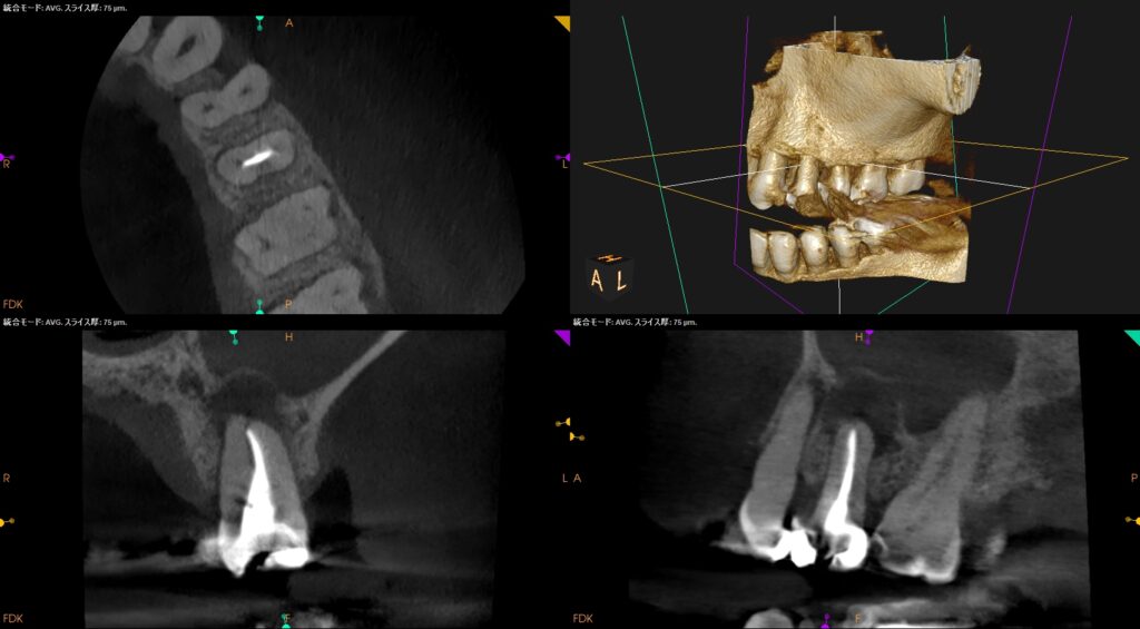 上顎洞炎を発生させた原因は?〜#13 RCT+Core build up with Fiber post - まつうら歯科医院 歯内療法専門室