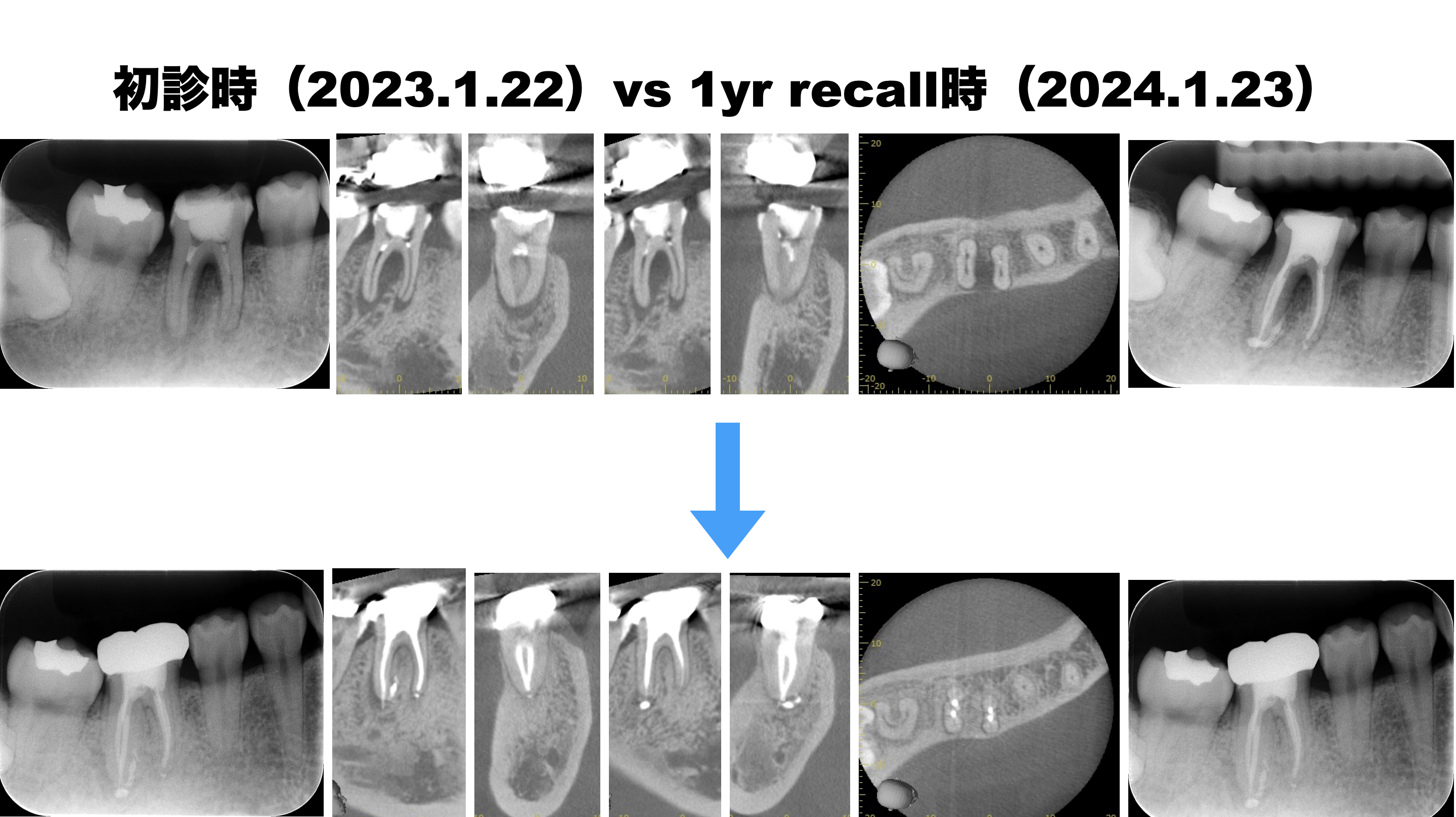 痛みは減少したが…最終補綴の装着どうする？〜#30 RCT 1yr recallと 