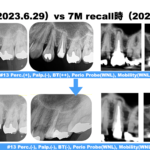 穿通しない？石灰化した根管を有する歯牙の再根管治療〜#13 Re-RCTと6M recall