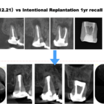 右上の奥歯が痛くて硬いものが噛めない。元のように噛みたい…#2 Intentional Replantationの1yr recallと同状況の#15との比較. 何が歯質の予後を左右するのか？
