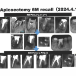 右下6のApicoectomyでも難易度が大幅に低下した理由とは？〜#30 Apicoectomy 6M recall