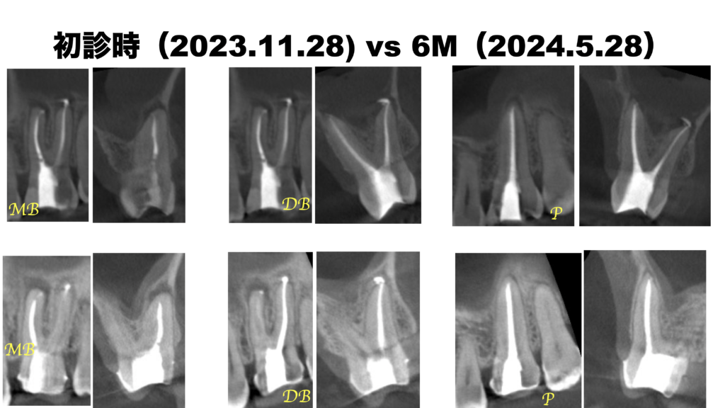 失活歯こリコンストラクション シエン社 | 失活歯のリコンストラクション