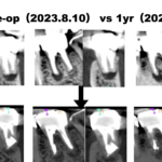 歯根端切除術を手早く終了させる臨床上の“コツ”とは？〜#19 Apicoectomy 1yr recall