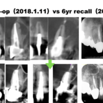 当歯科医院は患者さんが通り過ぎていく場所であり、長く停留する所ではない〜#6,7 Apicoectomy 6yr recall