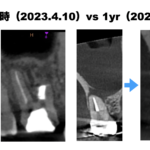 他院で治療したが治療中にパキッと音がした…歯にCrackが入っていないか不安…〜30分の#3 Apicoectomy 1yr recall