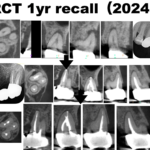 適切な根管充填ができているか？の臨床的確認方法（歯髄壊死＋根尖病変編）〜#15 RCT 1回法＋Core build up 1yr recall