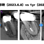 Re-RCTでは埒が開かなかった歯の外科治療〜#19 Apicoectomy 1yr recall