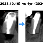 数年前にセラミック冠で被せた歯が痛い…#29 Apicoectomy 1yr recall