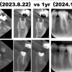 銀歯が取れて要抜歯と言われたが保存できないのか？〜#18 Re-RCT 1回法 1yr recall