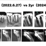 某美容歯科クリニックで行った治療のやり直し再根管治療〜#23,24,25,26 Re-RCT 2yr recall