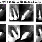 30年前に歯根端切除術をし、去年再・歯根端切除術をしたのに…問題発生。。。なぜ？〜#7 Apicoectomy, #10 Re×3-Apicoectomy 1yr recall