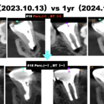 スキャンドネスト10本注射！！＆ 高血圧で歯科治療ができないと言われた患者さんの歯内療法外科治療〜#18 Intentional Replantation 1yr recall
