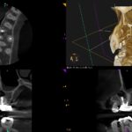 Root resection時の切断量に対する考え方〜#3 Apicoectomy