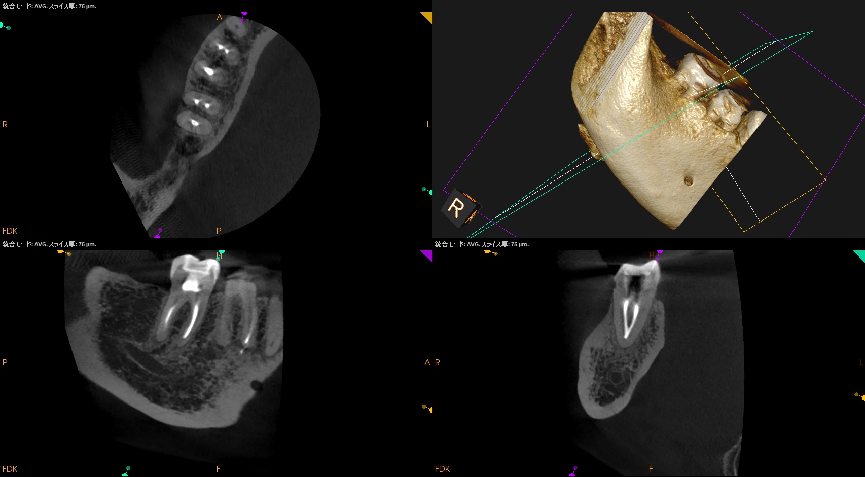 【裁断済み】治癒の歯内療法 ENDODONTICS 再生歯内療法 | 東京の歯内療法・根管治療専門 | 高林デンタル